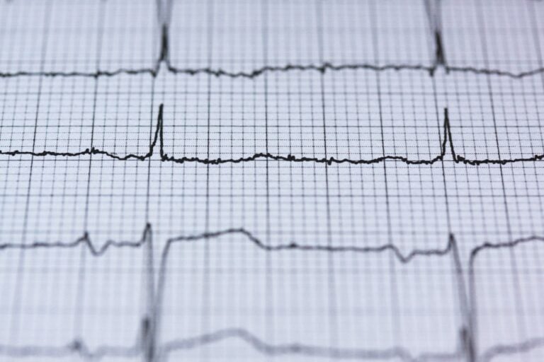 Serious Heart Rythms A self-supervised machine learning model for identifying abnormal heart ...